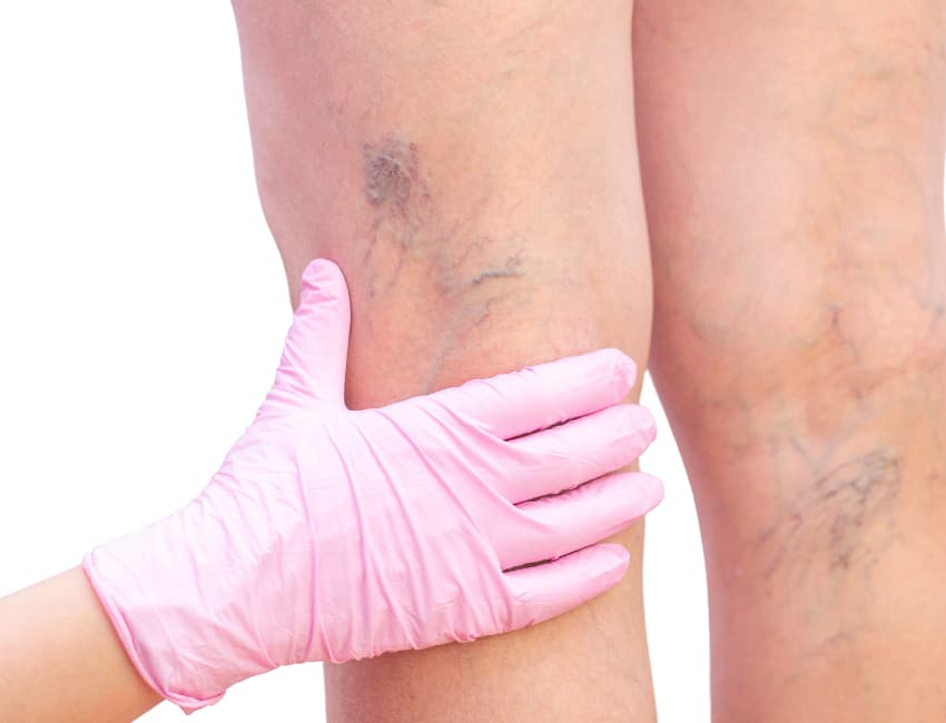 Varicose Veins Affect More Than Appearance - Vein Solutions