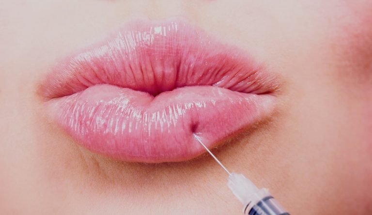 Dermal Lip Fillers FAQs - Vein Solutions