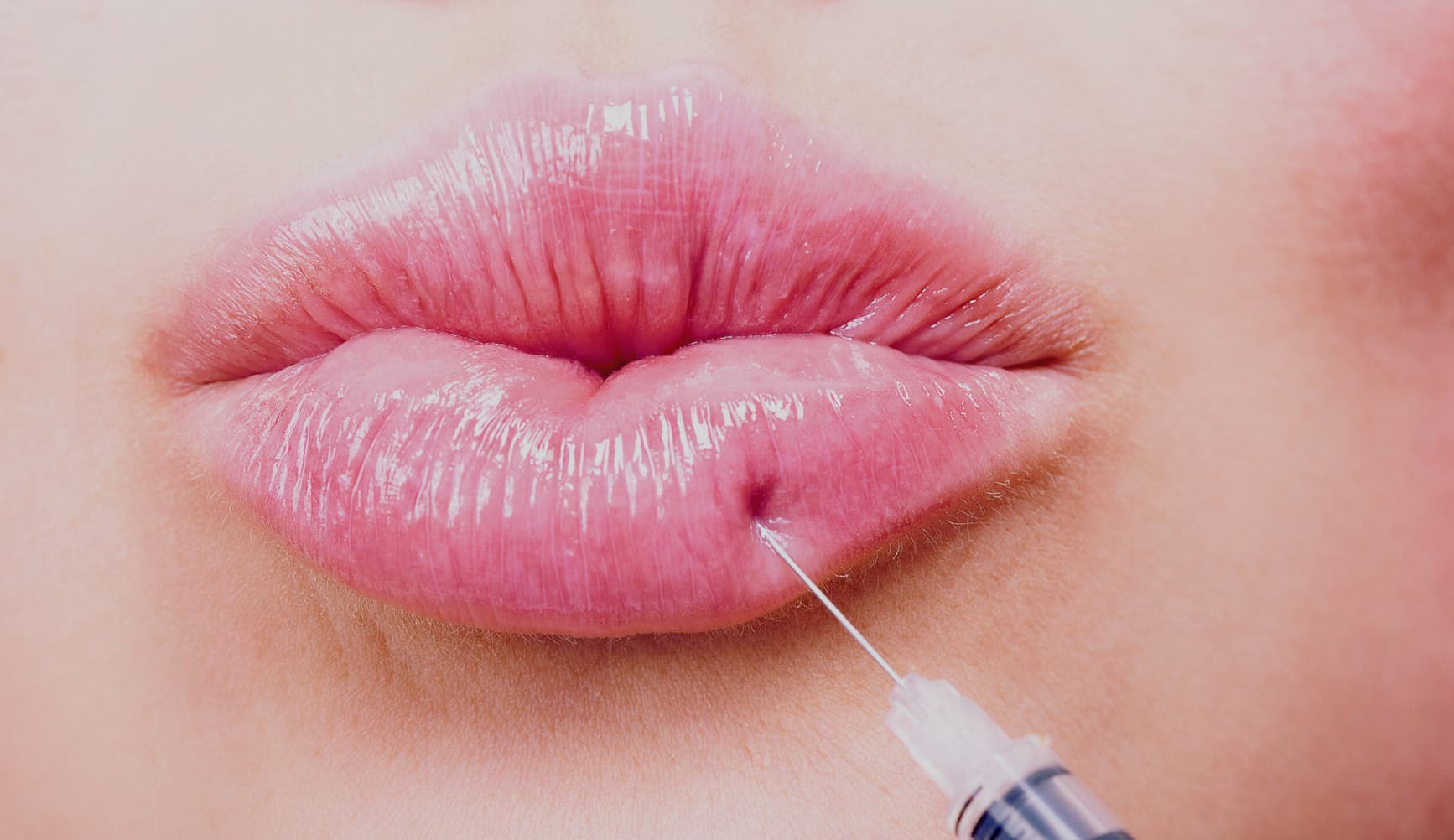 Dermal Lip Fillers FAQs - Vein Solutions