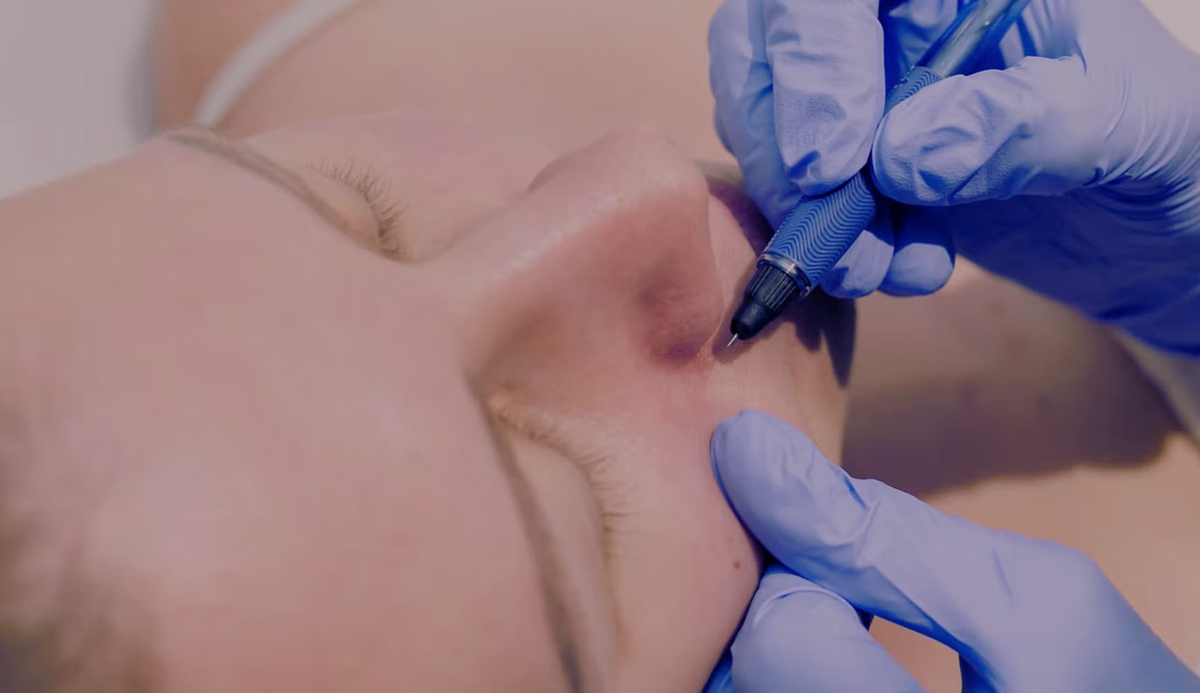 Thread Vein Treatment With Veinwave - Vein Solutions