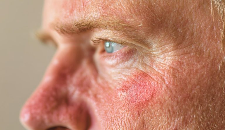 Rosacea: Symptoms, Types, Triggers and Treatments - Vein Solutions