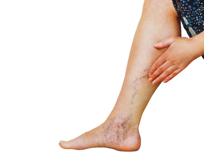 How Common are Varicose Veins? - Vein Solutions